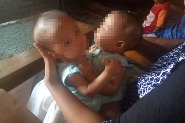 Bayi Kembar Siam Dempet Dada hingga Kaki Asal Semin dalam Kondisi Sehat