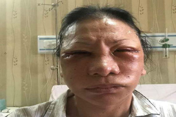 Berbuntut Panjang, Gara-Gara Kasus Wajah Ratna Sarumpaet Bonyok, Prabowo Subianto Akan Dipolisikan
