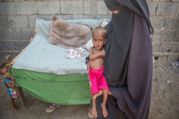 Tragis, Akibat Perang 85.000 Balita di Yaman Tewas karena Kekurangan Gizi