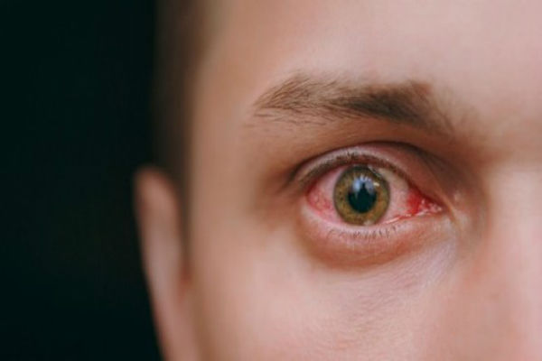 Mata Gatal Ternyata Bisa Jadi Tanda Tumor Otak