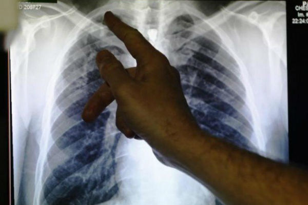 Kasus Pneumonia Indonesia Peringkat 7 Dunia