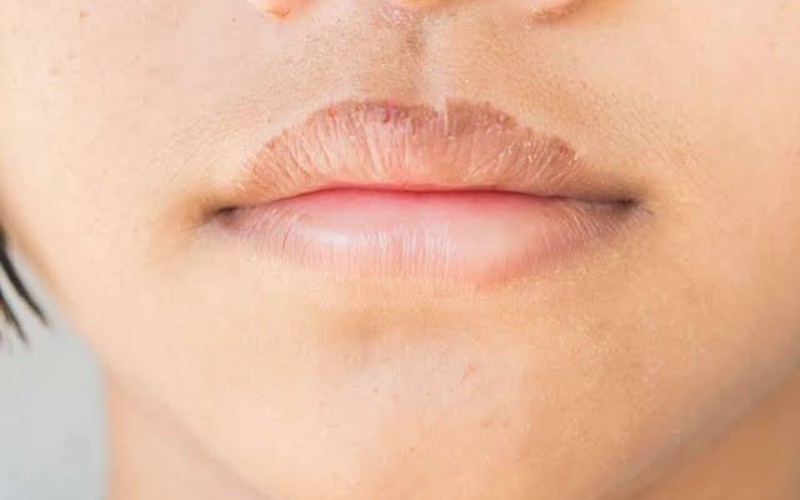 Cek Fakta: Benarkah Bibir Kering dan Bersisik Jadi Gejala Virus Corona?