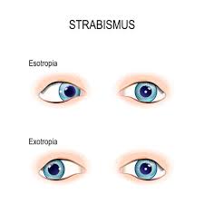 Squint Eyes Can Be Repaired If Treated Early