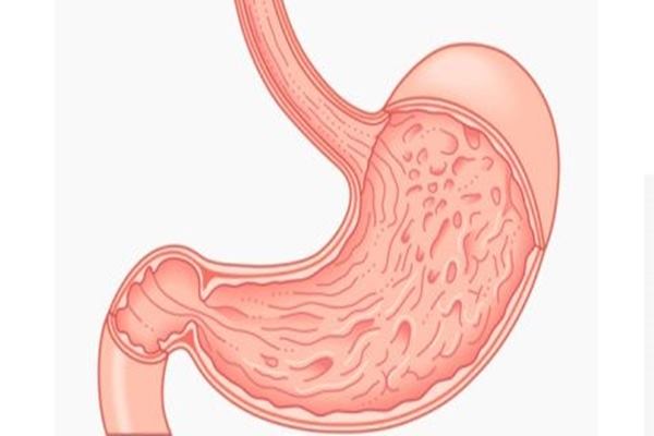 Early Detection of Gastric Cancer Symptoms, These are 6 Conditions to Watch Out for