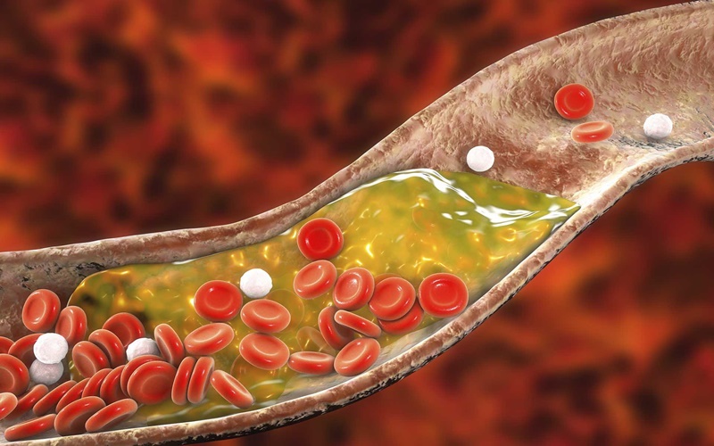Begini 10 Cara Turunkan Kolesterol Secara Alami, Tanpa Obat