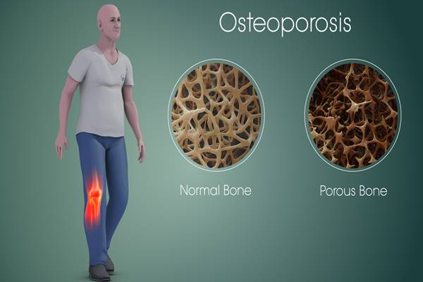 Untuk Kaum Rebahan, Simak Nih, Mager bisa Bikin Osteoporosis