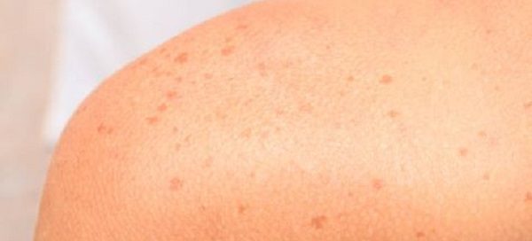 12 Tanda di Kulit Ini Jadi Gejala Awal Diabetes