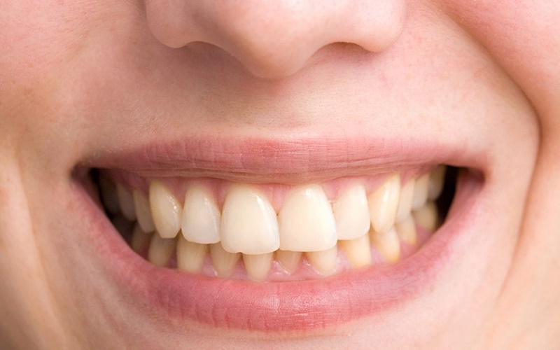 Sering Alami Ngilu Gigi? Ini Tips Ampuh untuk Mencegahnya