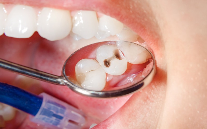 Hal yang Perlu Diperhatikan Sebelum Mencabut Gigi