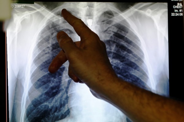 Begini Cara Membersihkan Paru-paru secara Alami untuk Perokok