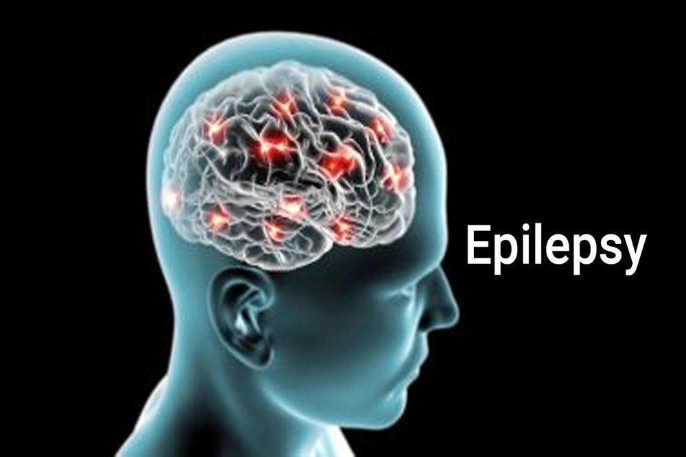 Kenali Gejala Awal Epilepsi, Jangan Diabaikan