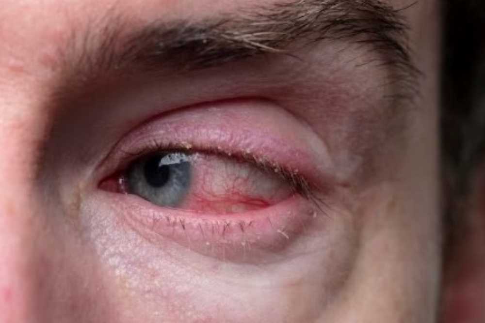 Kelopak Mata Bengkak, Bisa Jadi Pertanda 5 Penyakit Ini