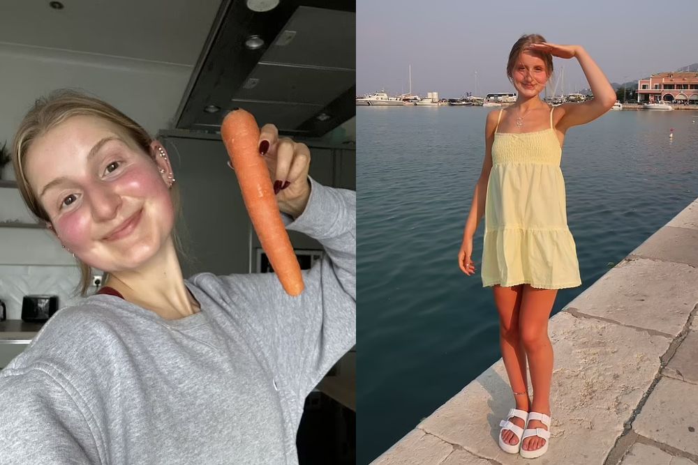 Makan 10 Wortel Sehari, Kulit Perempuan Ini Berubah Jadi Oranye