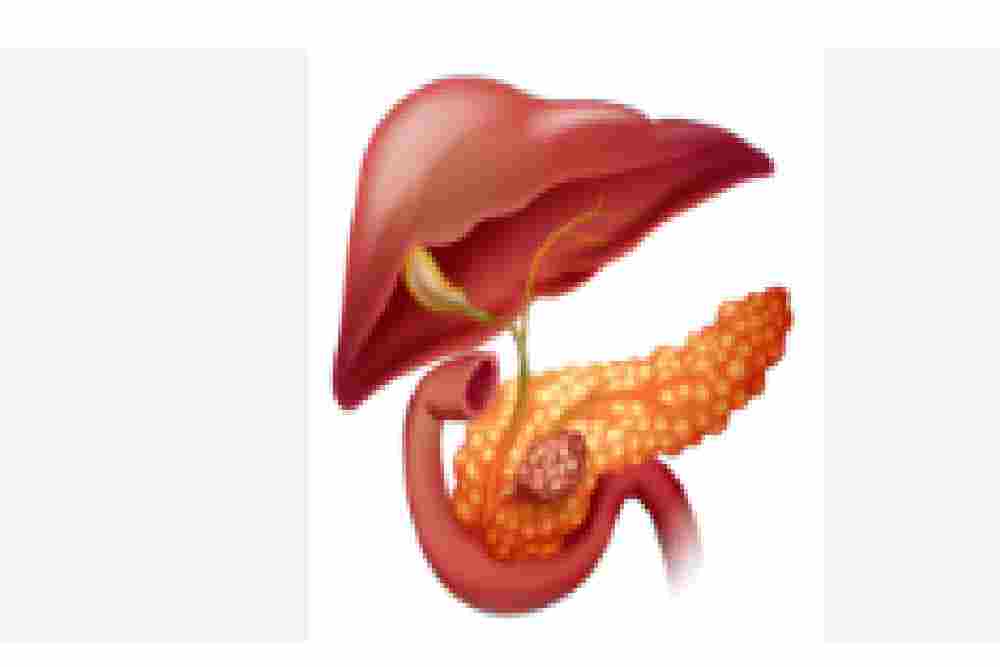 AI Ungguli Radiolog dalam Deteksi Dini Kanker Pankreas