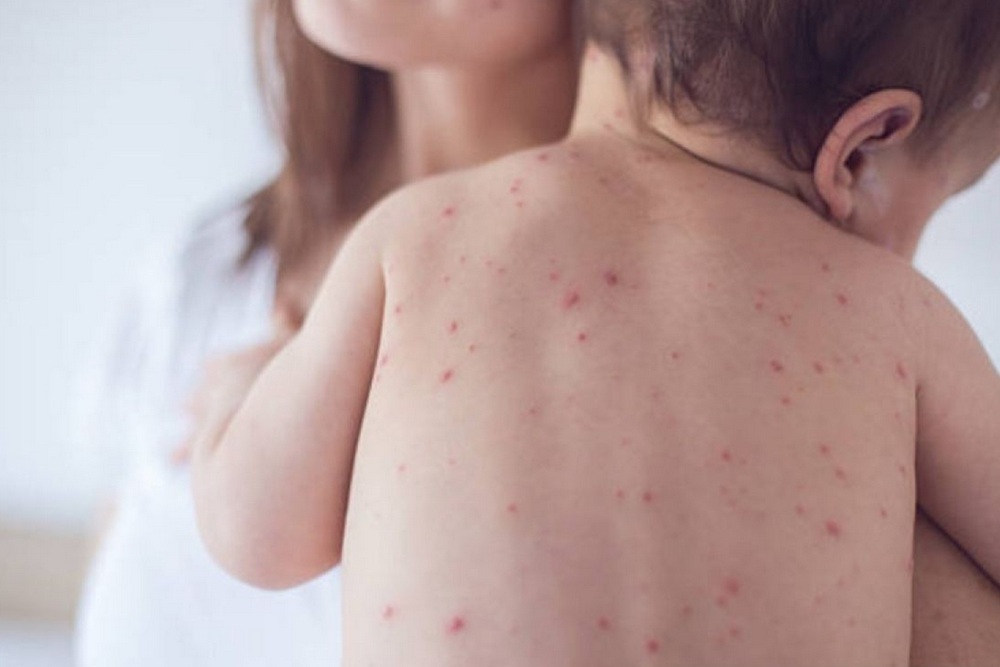 Wabah Campak Mematikan di Bangladesh, 294 Anak Tewas