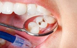 Hal yang Perlu Diperhatikan Sebelum Mencabut Gigi