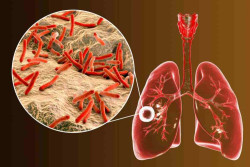 Begini Cara Cegah Penularan TBC Menurut Zero TB