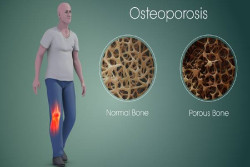 4 Penyebab Utama Osteoporosis pada Perempuan, Yuk Baca Penjelasannya di Sini