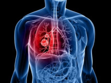 Daftar Penyebab Kanker Paru Selain Perokok, Ada Polusi Udara