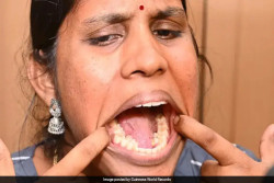 Punya 38 Gigi, Wanita India Pecahkan Rekor Pemilik Gigi Terbanyak di Dunia