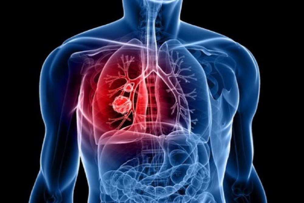 Ahli Sebut 85 Persen Kanker Paru Berhubungan dengan Kebiasaan Merokok