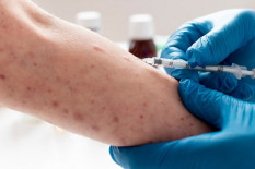 Belanda Konfirmasi Kasus Pertama Varian Baru Mpox