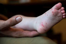 Waspada, Dinkes Jogja Catat 194 Dugaan Kasus Flu Singapura