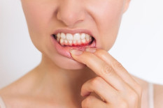 Penyakit Gusi Sering Diabaikan, Bisa Picu Penyakit Metabolik